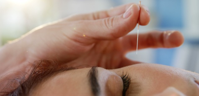 facial-acupuncture-on-female-close-up