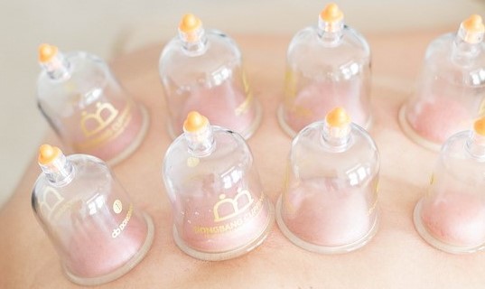 Clinical wet cupping suction cups placed on a patient's skin at Acufy Clinic in Essex, showing the safe negative pressure vacuum gradient used to clear microvascular congestion and prepare tissues for traditional clinical Hijama therapy in our Maldon treatment rooms.