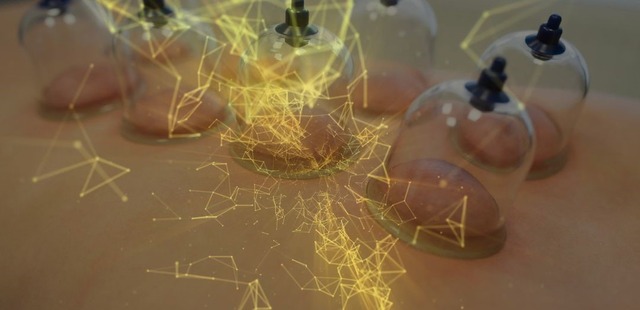 cupping-therapy-with-futuristic-digital-overlay-illustrating-healing Clinical dry cupping therapy session at Acufy Clinic in Essex, showing a specialized vacuum cup layout to demonstrate the biomechanical myofascial decompression and peer-reviewed science behind our care in Maldon.