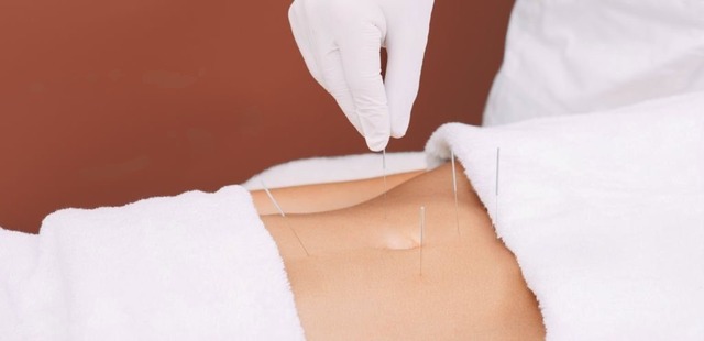 A close-up shot of a specialized clinical needling session utilizing modern abdominal acupuncture protocols. Ultra-fine needles are placed into the superficial abdominal fascial layers to stimulate the enteric nervous system and relieve chronic pain.
